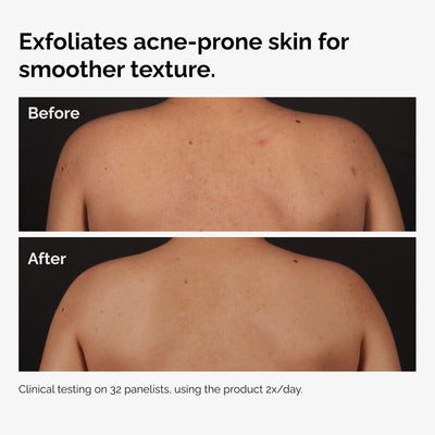 The Ordinary Serum Corporal Ácido Salicílico 0,5% - 240ml - Farmacias Curie